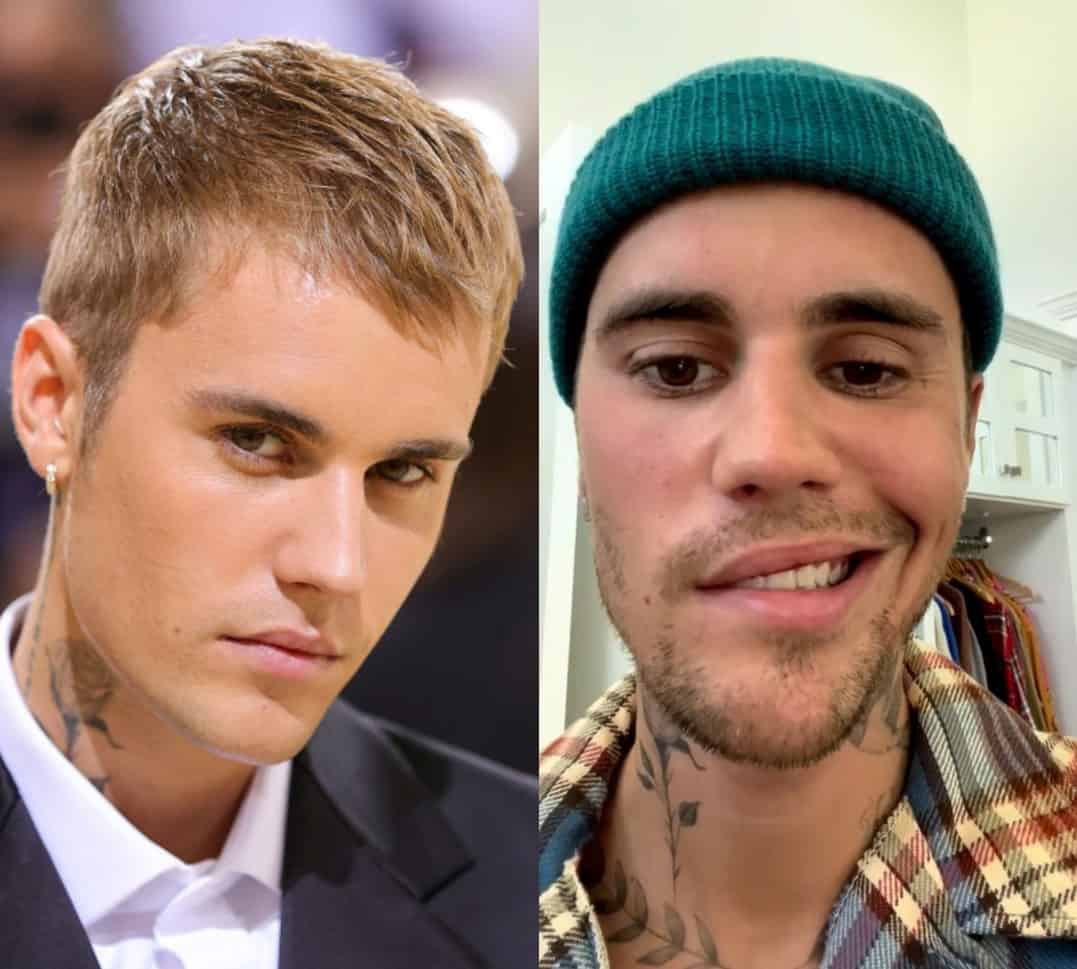 Justin Bieber Is Diagnosed With Ramsey Hunt Syndrome Which Caused Facial Paralysis